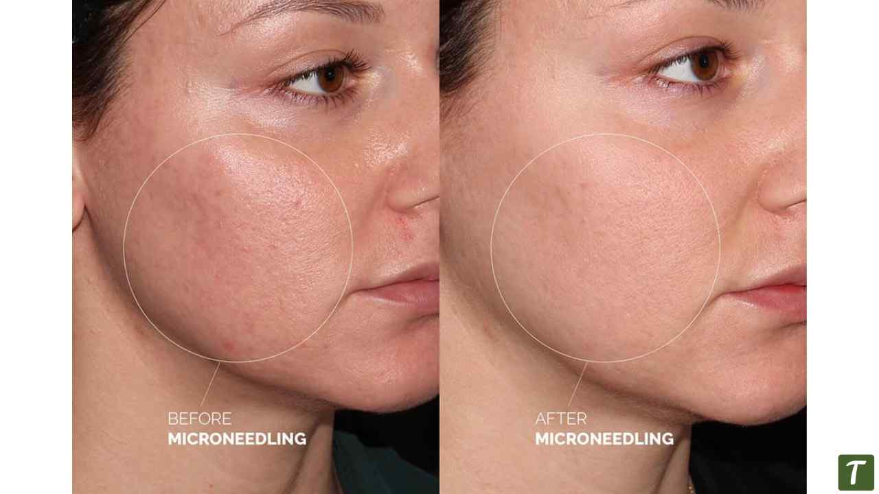 Microneedling before after